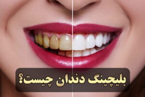 بلچینگ دندان چیست؟
